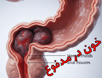 خون در مدفوع نشانه سرطان است؟ راهنمای کامل ۲۰۲۵