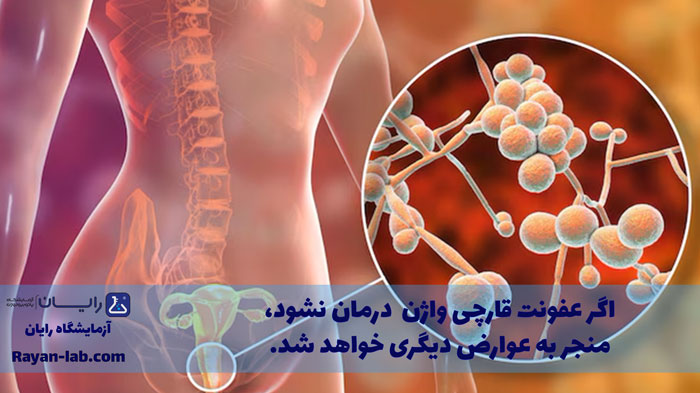 عفونت قارچی واژن چیست-1