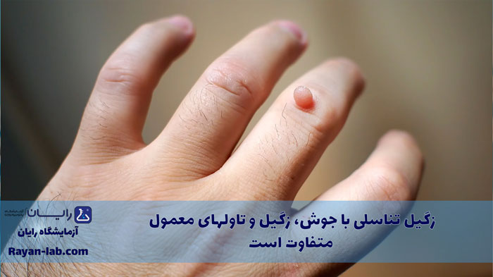 عکس زگیل تناسلی