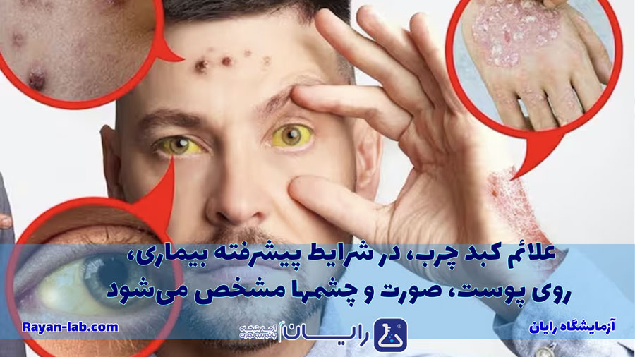 علائم کبد چرب در چهره