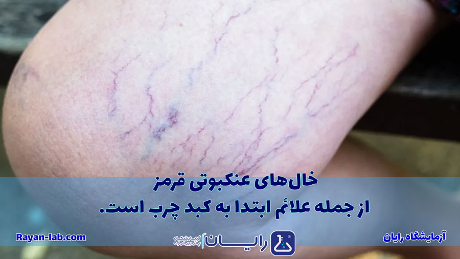 علائم کبد چرب در پا