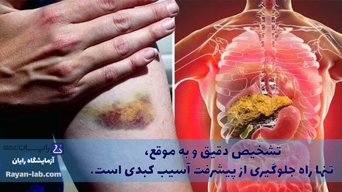 علائم کبد چرب گرید 1 چیست