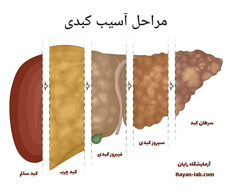 علائم خطرناک کبد چرب چیست؟؟