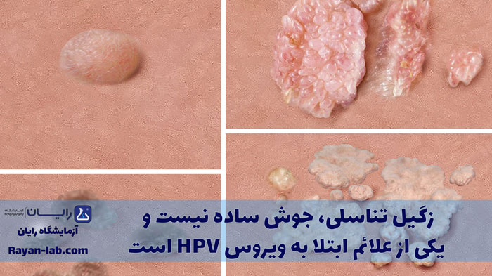 علائم زگیل تناسلی در مردان چیست
