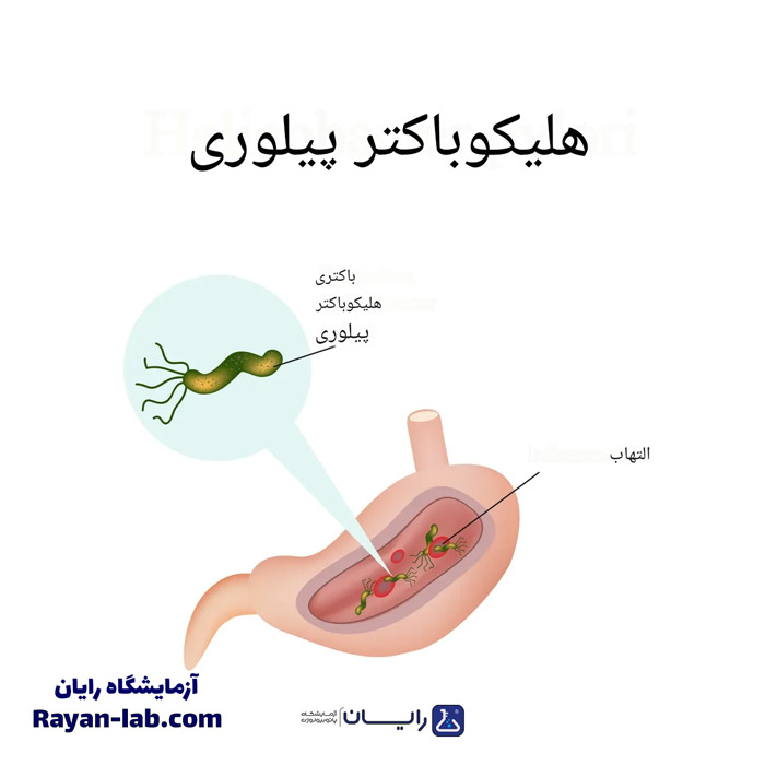 اچ پیلوری چیست