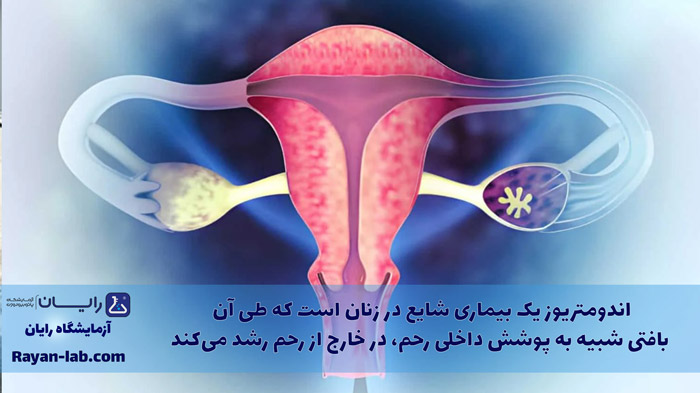 اندومتریوز شیراز