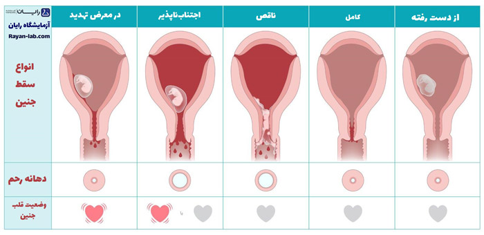 انواع سقط جنین