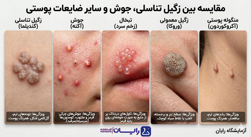 فرق زگیل تناسلی و جوش