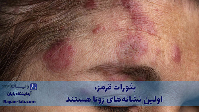 فرق زونا و آبله مرغون
