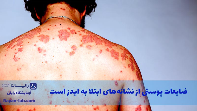 علائم ایدز در مردان چیست