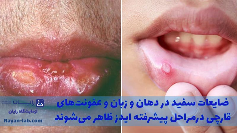 علائم پیشرفته ایدز در مردان