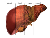علائم خطرناک کبد چرب چیست؟ + چه آزمایشهایی باید انجام دهیم