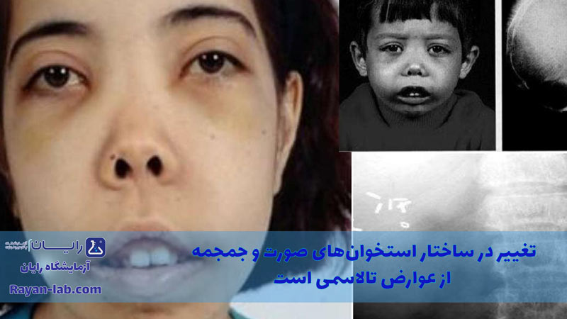 علائم تالاسمی مینور در بزرگسالان