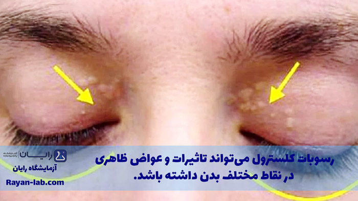 آزمایش چربی خون در منزل شیراز