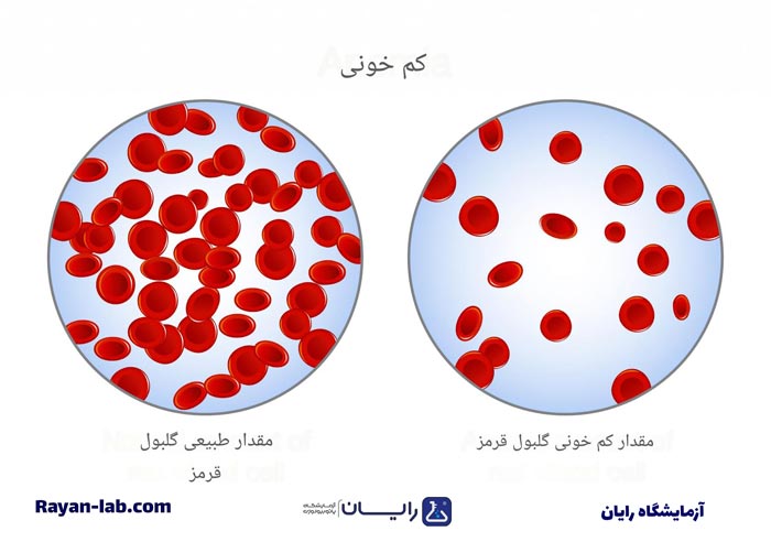 کم خونی یعنی چه؟