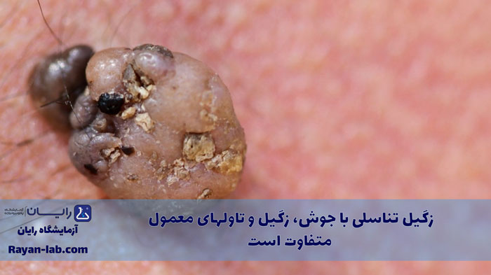 شکل زگیل تناسلی در زنان
