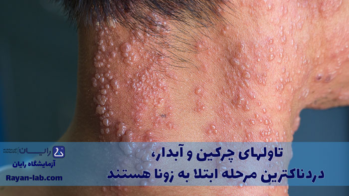 تاول زونا چیست