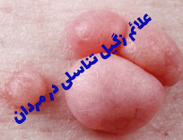 عکس و علائم زگیل تناسلی در مردان | تشخیص و درمان (آپدیت 2025)