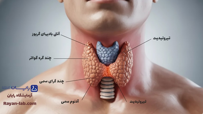 تیروئید پرکار چیست