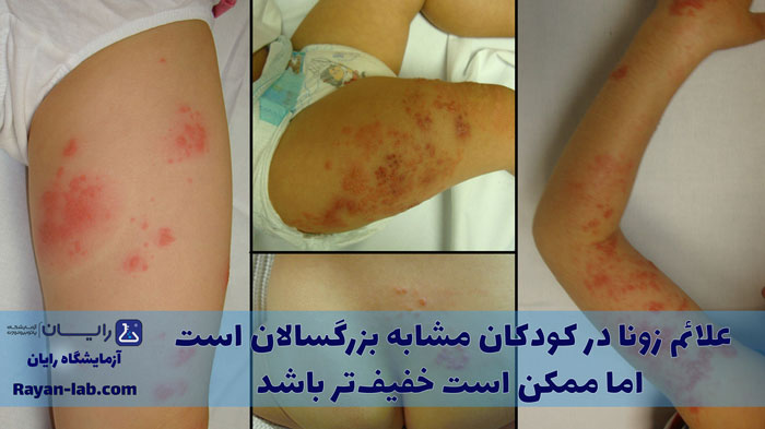 زونا در کودکان چطوریه؟