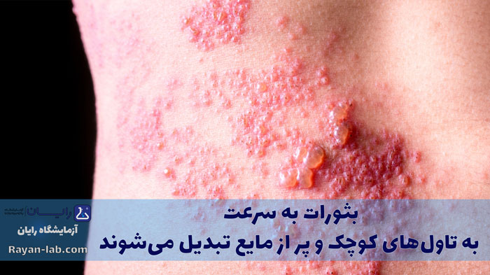 زونا یعنی چی؟
